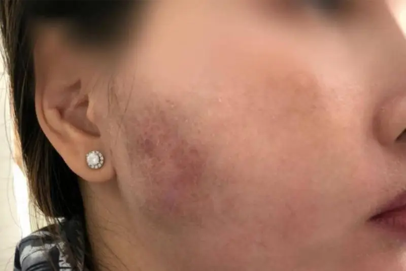 Những ai không phù hợp tiêm filler ngay — chống chỉ định và cần cân nhắc đặc biệt?