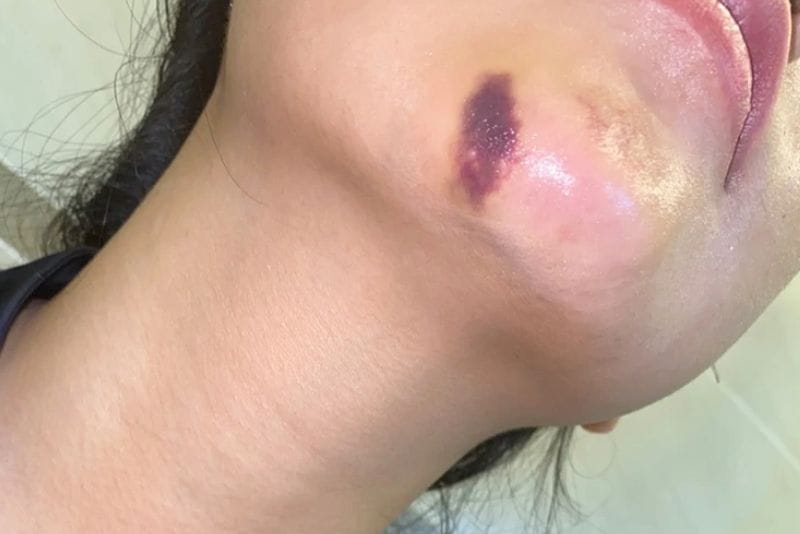 Những bằng chứng chuyên môn và nghiên cứu gần đây cho thấy điều gì về xử trí biến chứng?