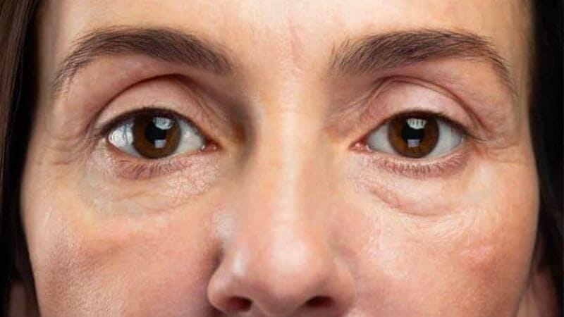 Trũng mắt dưới của tôi là do mỡ thoát vị hay do mất thể tích — làm sao phân biệt?