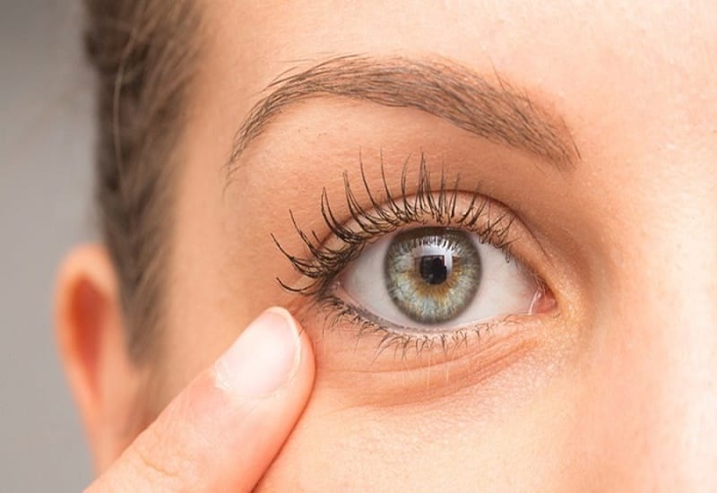 Tiêm filler rãnh lệ (hyaluronic acid) — lợi ích và giới hạn