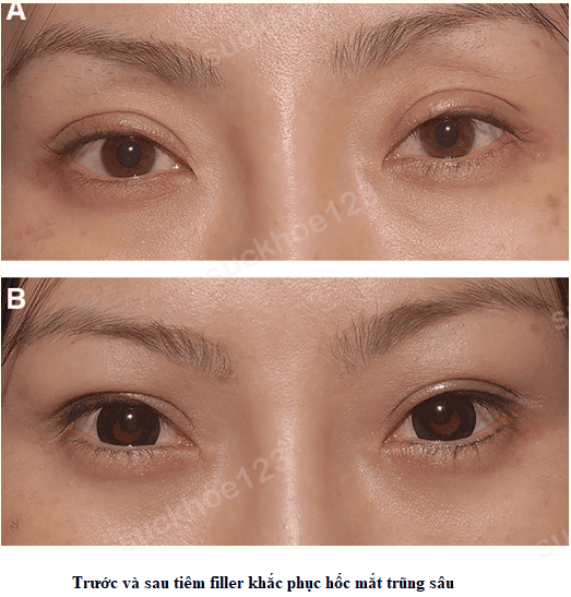 Phẫu thuật cắt mí dưới (dời/điều chỉnh túi mỡ — lower blepharoplasty) — khi nào cần mổ?