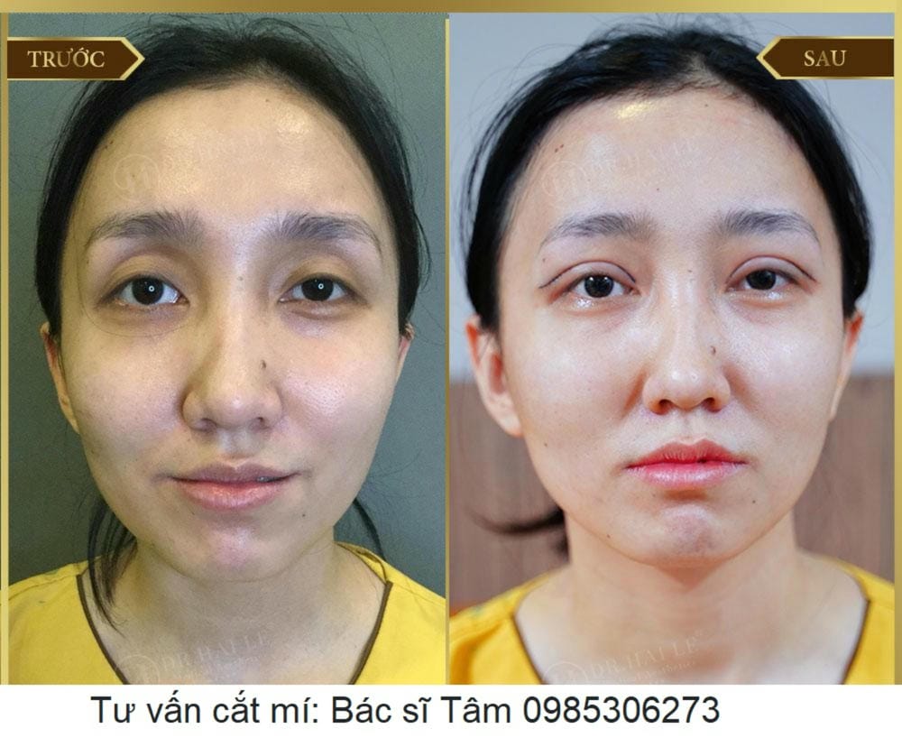 So sánh ngắn: filler, ghép mỡ và phẫu thuật — lựa chọn nào dễ chuyển đổi nhất?