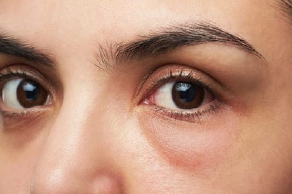 Quy trình điển hình khi thực hiện tiêm filler vùng trũng mắt — từng bước cần biết