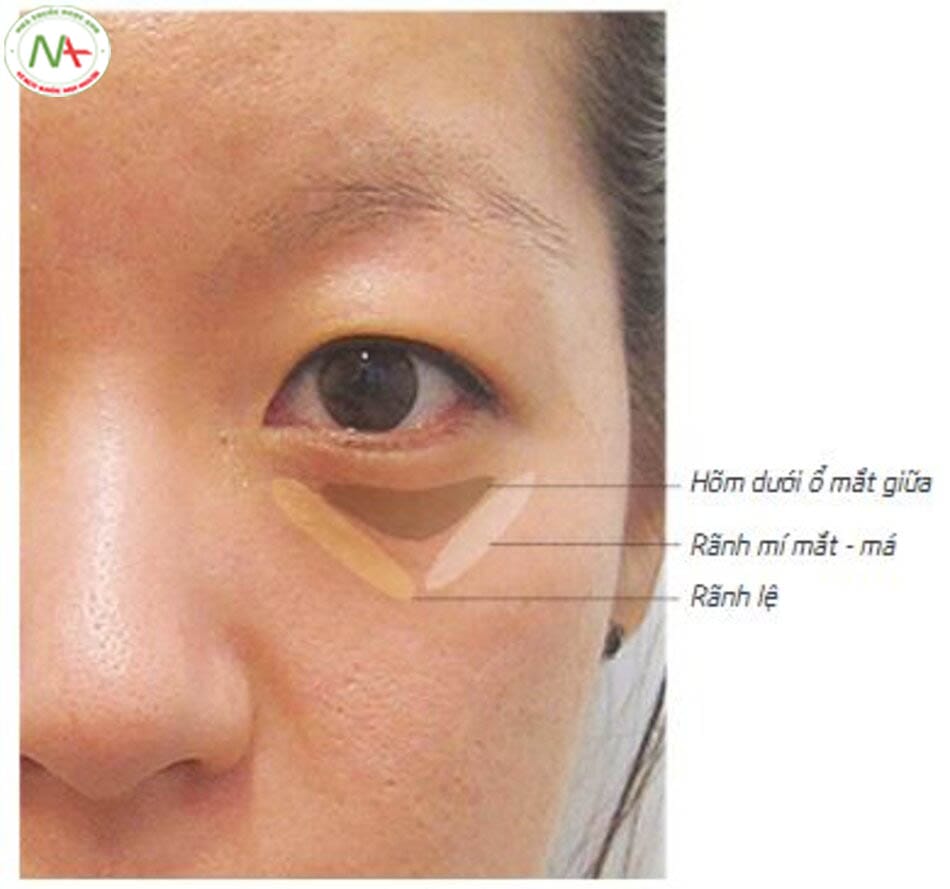 Rủi ro, tác dụng phụ và ai không phù hợp để làm ngay