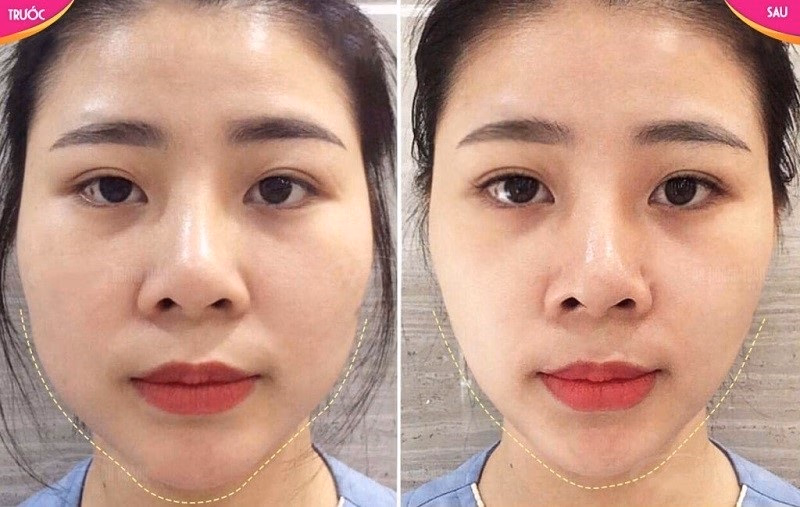 Kết quả xuất hiện khi nào và kéo dài bao lâu? Tôi cần tiêm lặp lại mấy lần?