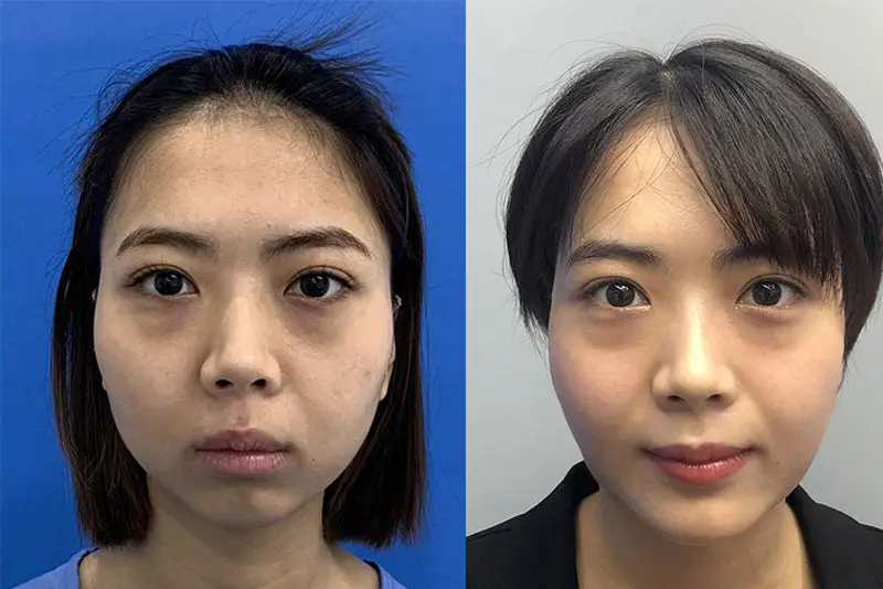 Trượt cằm so với độn cằm implant và tiêm filler cằm — chọn phương pháp nào?