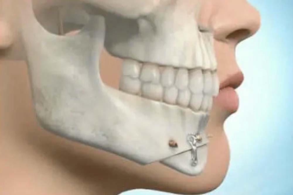 Những rủi ro và biến chứng có thể gặp khi trượt cằm?