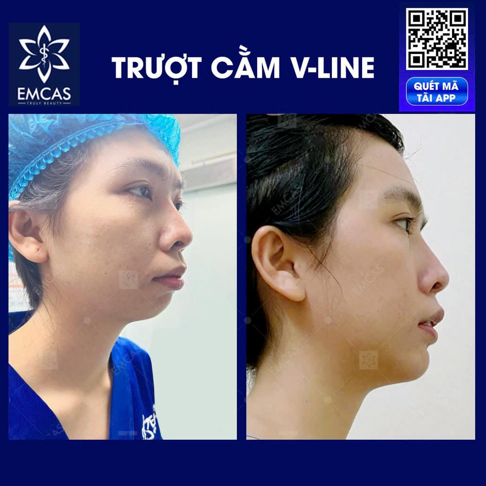 Lưu ý chăm sóc sau mổ: làm thế nào để hồi phục tốt và giảm biến chứng?