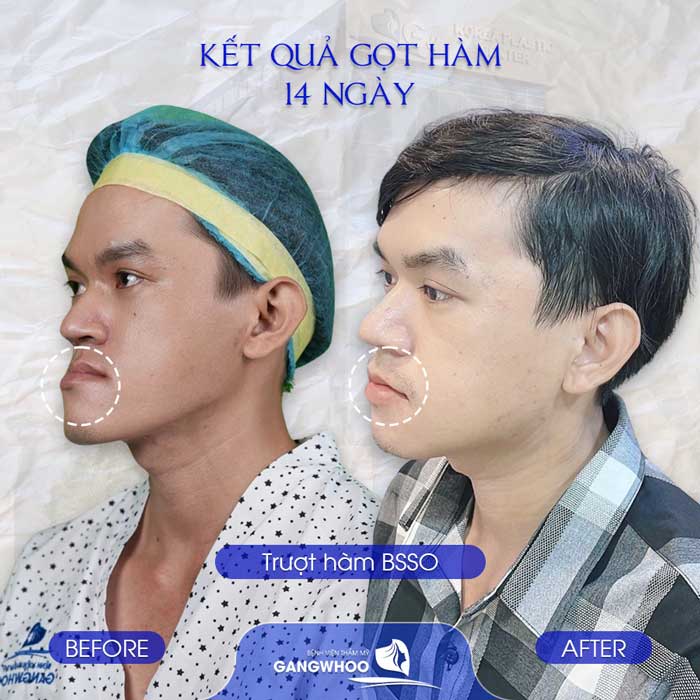 Bao lâu thì cảm giác vùng cằm hồi phục nếu bị tê?