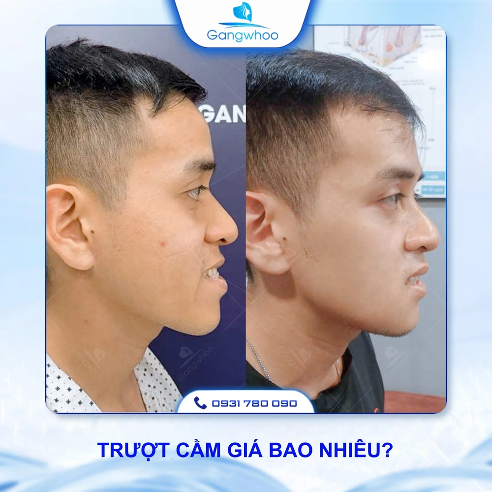 Quy trình trượt cằm diễn ra như thế nào — từng bước và thời gian phục hồi