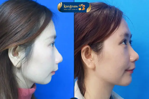 Trượt cằm hay chọn phương án khác — làm sao quyết định?