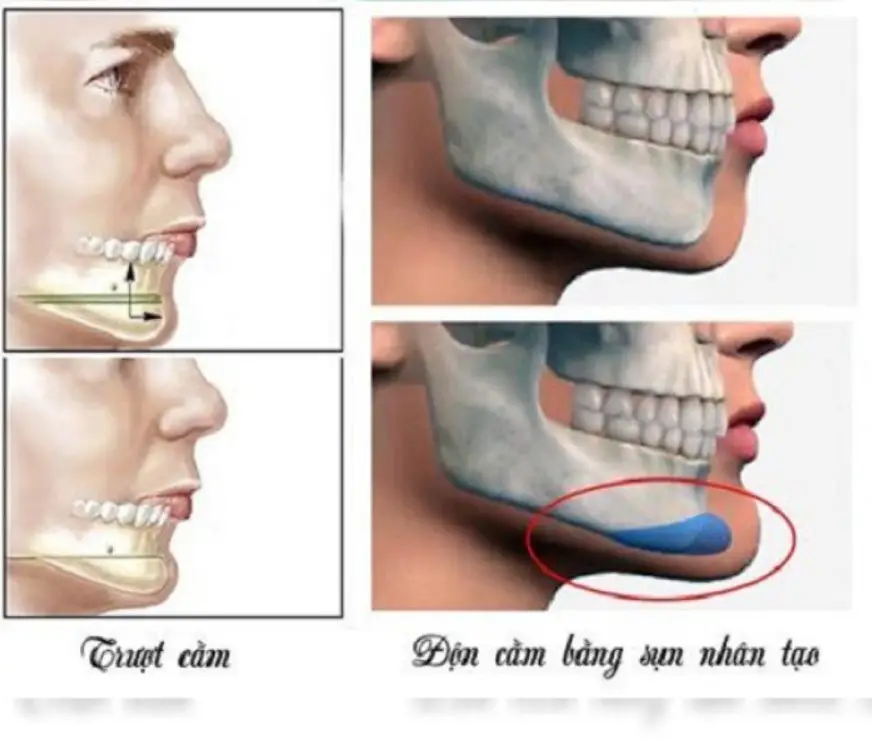 Trượt cằm khác gì với độn cằm bằng implant hay tiêm filler cằm?