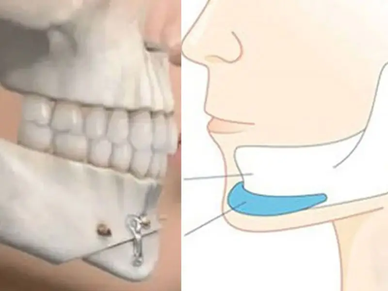 Quy trình trượt cằm diễn ra như thế nào và cần chuẩn bị gì?