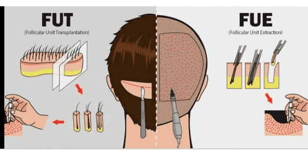 Vì sao có thể hoại tử hoặc mất mô — cơ chế và tác động đến tỷ lệ sống graft?