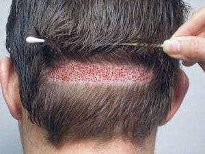 Dấu hiệu cảnh báo sớm — khi nào cần liên hệ bác sĩ ngay để tránh nhiễm trùng da đầu?