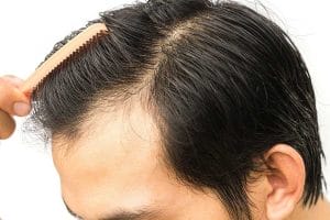 Cách chọn nơi thực hiện để giảm nhiễm trùng da đầu và sẹo