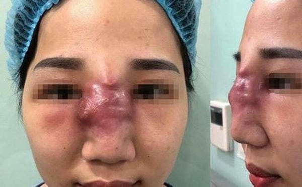 Loại filler nào an toàn hơn — so sánh: Hyaluronic acid vs các chất làm đầy khác?