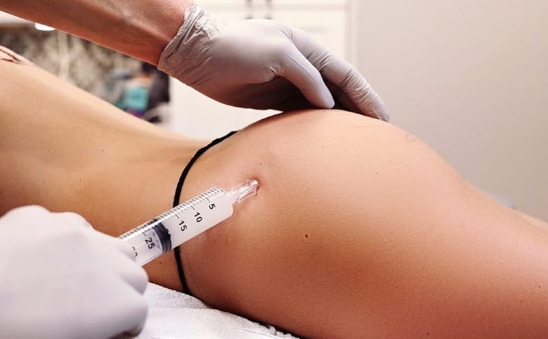 So sánh: Tiêm filler mông, cấy mỡ tự thân (BBL) và đặt túi mông — phương pháp nào an toàn hơn?