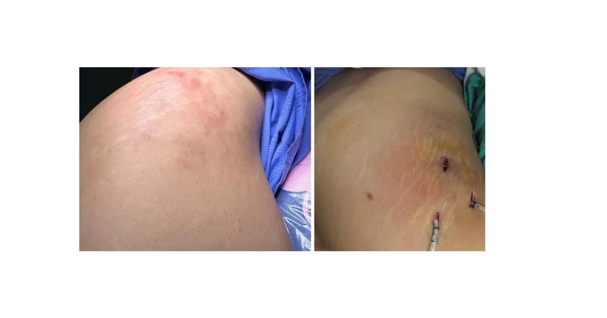 Ai không nên tiêm filler mông — chống chỉ định và lưu ý chăm sóc trước/sau?