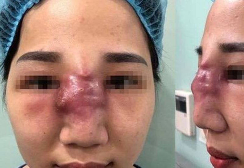 Làm sao để giảm thiểu rủi ro — chọn filler, bác sĩ và nơi tiêm như thế nào?