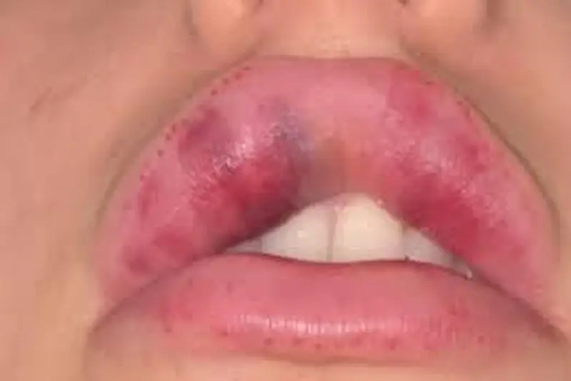 Phản ứng muộn: nốt viêm, granuloma, nhiễm khuẩn do biofilm — dấu hiệu và cách điều trị