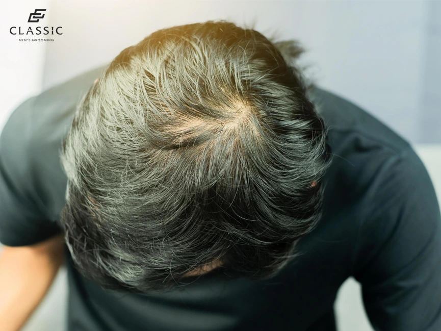 Nguyên nhân rụng tóc nam: tại sao tóc nam lại thưa và mỏng — có phải chỉ do di truyền?