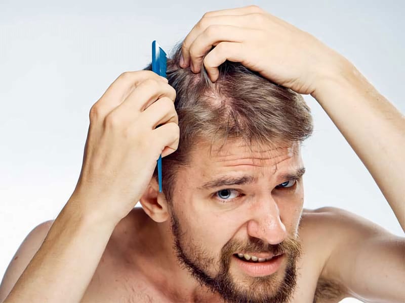 Thuốc uống: Finasteride và lưu ý quan trọng khi dùng thuốc hệ thống