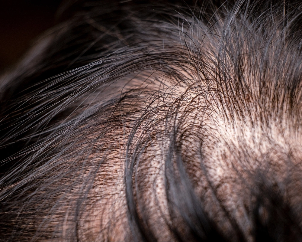 Low‑dose oral minoxidil (LDOM)
