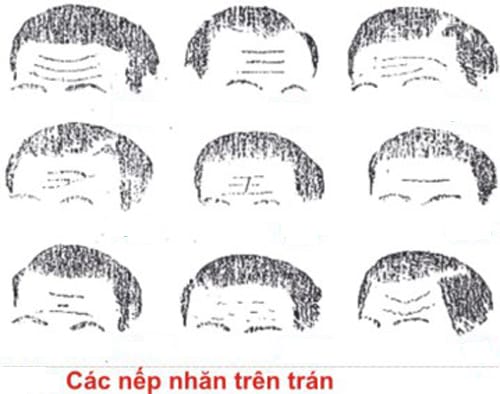 Điều trị nếp nhăn động bằng botulinum toxin