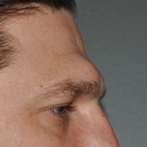 Laser tái tạo bề mặt, vi kim (microneedling) và PRP