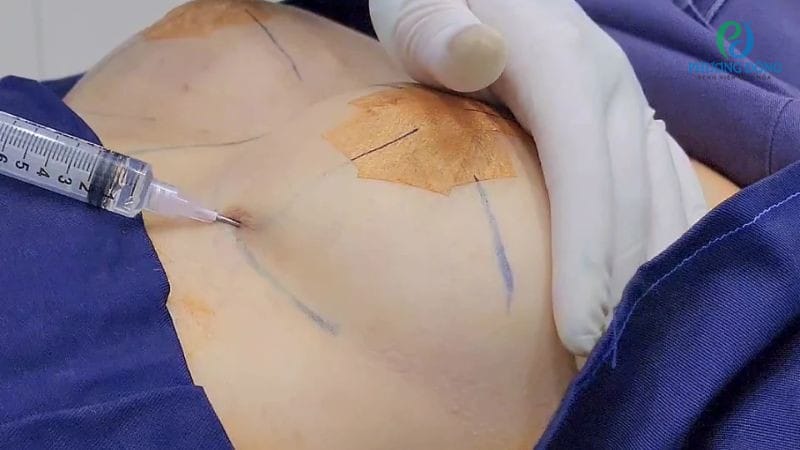 Bằng chứng lâm sàng và FDA cảnh báo filler ngực