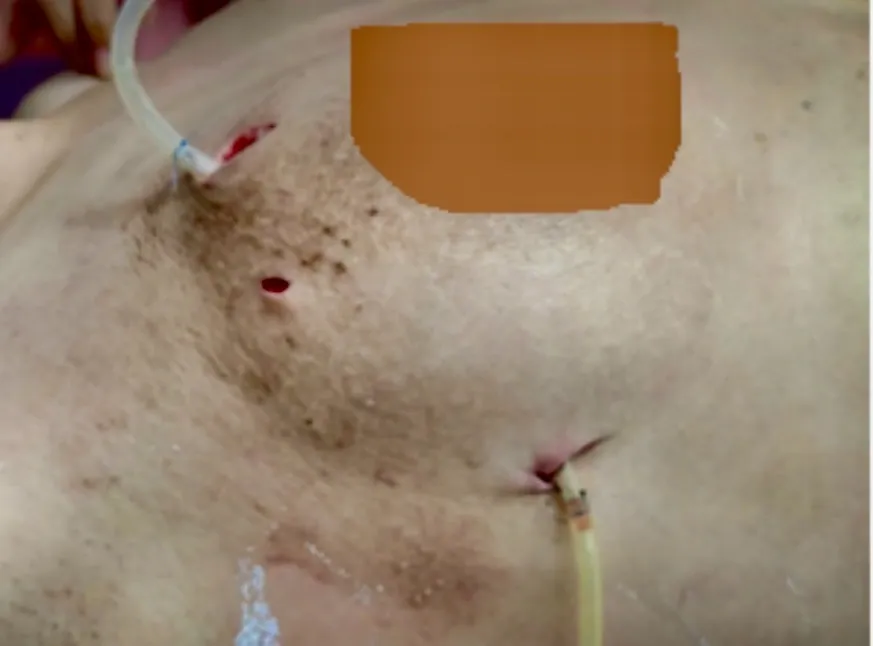 Nếu đã tiêm filler vào ngực thì cần làm gì?