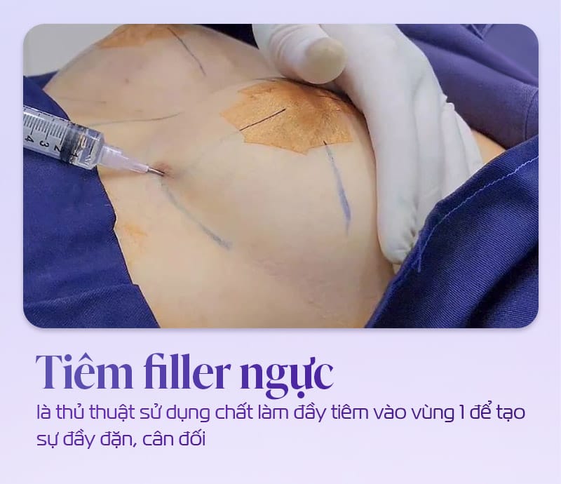 Ai không nên cân nhắc tiêm filler vào ngực?