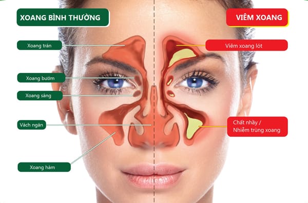 Nếu đã tiêm filler và xuất hiện sưng, đỏ, đau