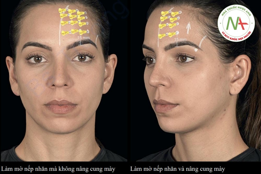 Tiêm ở vùng trán và giữa lông mày: kỹ thuật tiêm botox để không bị sụp mi hoặc mất biểu cảm