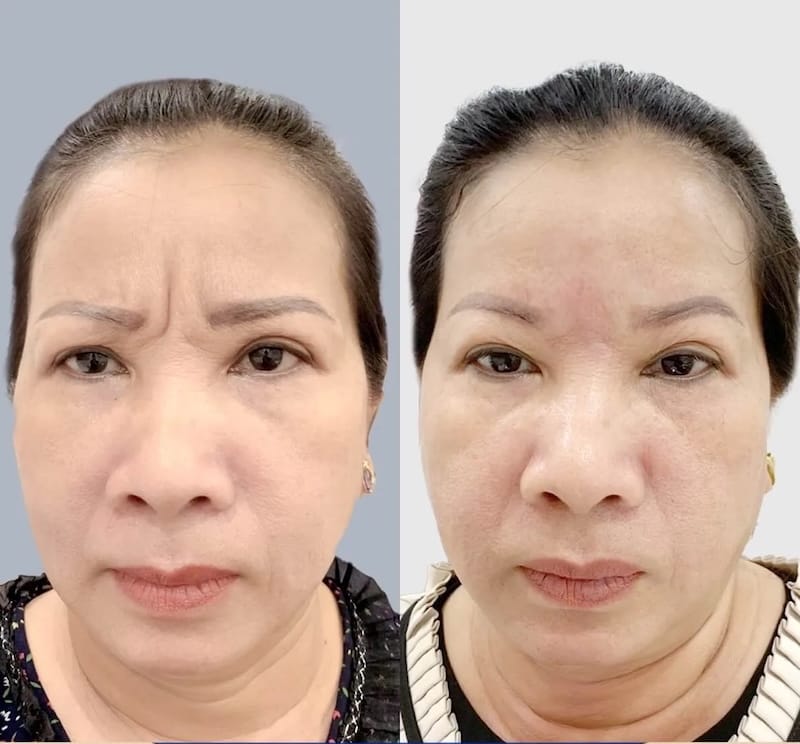 Tại sao nếp cau mày xuất hiện và có thể phòng ngừa được không?