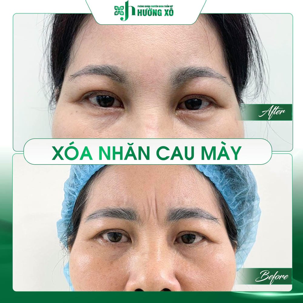 Lợi ích khi tiêm botox cau mày