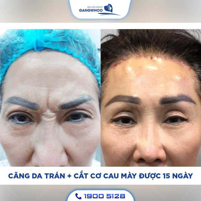 Bằng chứng lâm sàng và cập nhật quan trọng gần đây về điều trị nếp cau mày