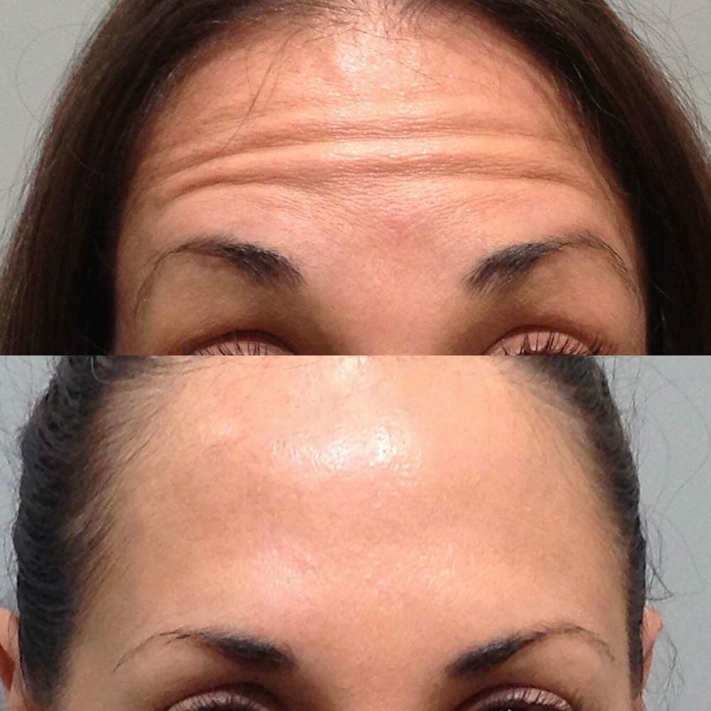 Ai phù hợp và ai không phù hợp để xoá nhăn trán bằng Botox?