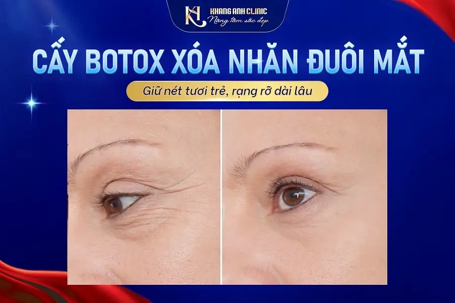 Có loại botulinum toxin mới hoặc kỹ thuật cải tiến nào?