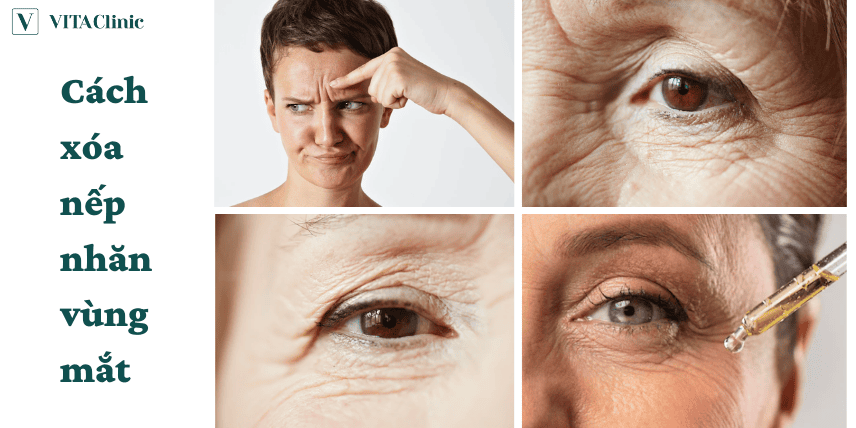 Có thật xóa nếp nhăn vùng mắt tại nhà được không — hiệu quả mong đợi thế nào?