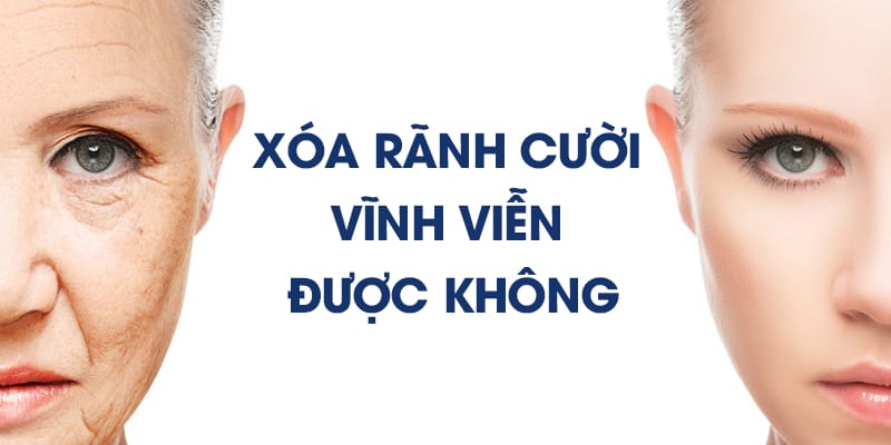 Xóa rãnh cười vĩnh viễn có thực sự tồn tại không và nên hiểu vĩnh viễn thế nào?