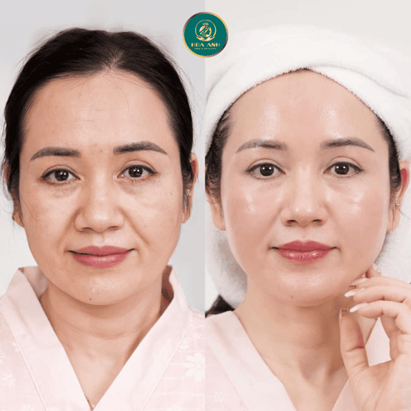 Những phương pháp nào có thể duy trì lâu dài: filler, mỡ tự thân hay phẫu thuật?