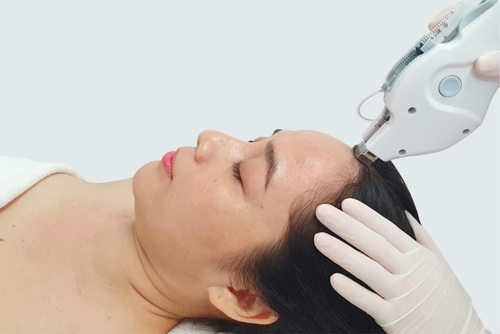 Lộ trình điều trị tại clinic: quy trình của mesotherapy da đầu với thiết bị