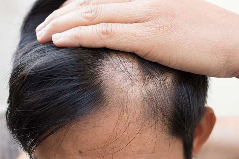 Phẫu thuật cấy tóc FUE: khi nào nên cân nhắc và cần chuẩn bị gì?