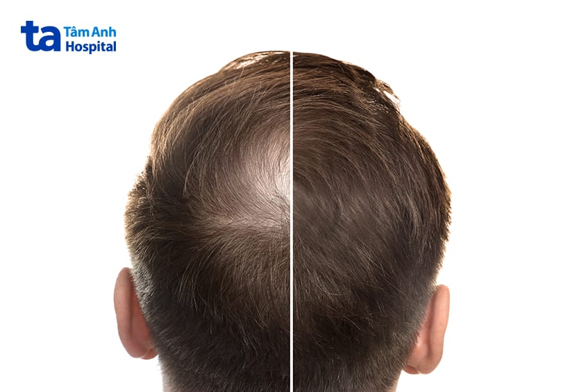 Tại sao tóc rụng nhiều ở Cao Lãnh — những nguyên nhân phổ biến