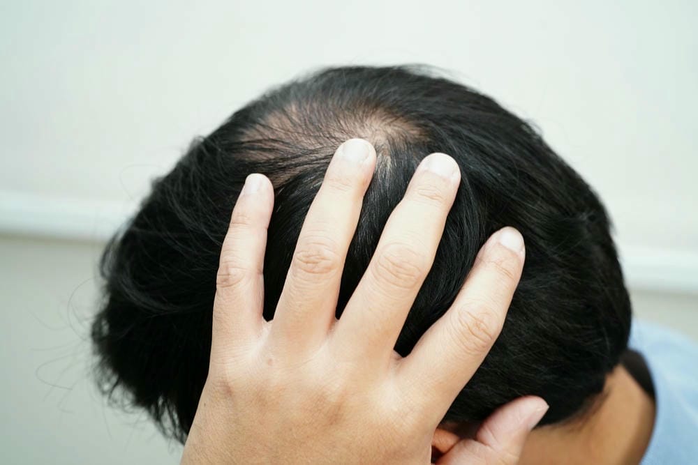 Phương pháp nào phù hợp cho tình trạng rụng tóc của mình — thuốc, liệu pháp hay phẫu thuật?