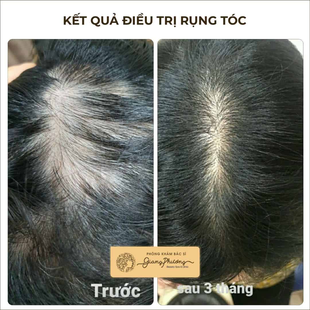 PRP, lăn kim, cấy tóc — thật sự hiệu quả và an toàn đến đâu?