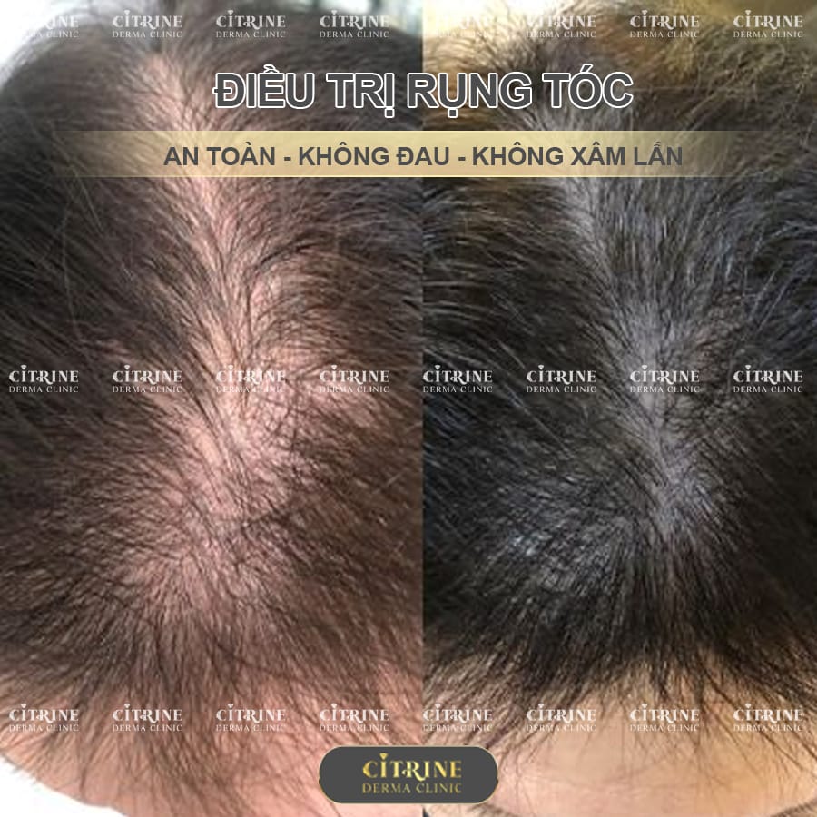 Khi nào cần cân nhắc cấy tóc FUE — và quy trình cơ bản như thế nào?