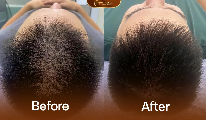 So sánh nhanh: thuốc, công nghệ và cấy tóc — ưu, nhược, phù hợp với ai?